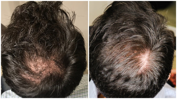 Virtual Hair Restoration Consultation & Scalp Analysis
